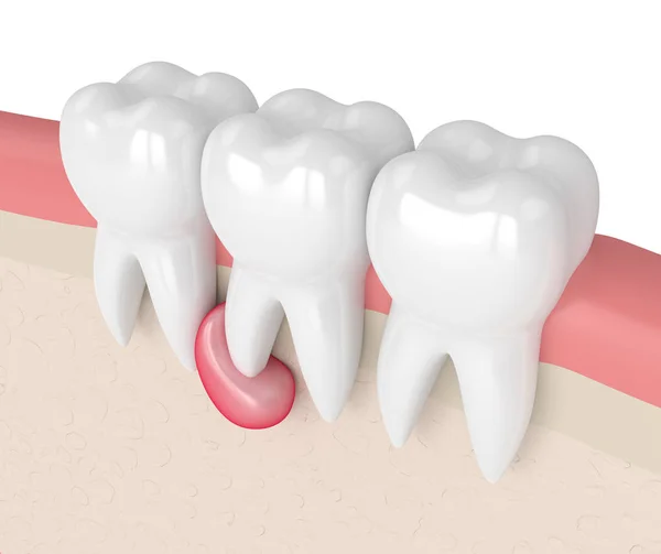 3d render of teeth in gums with cyst — Stock Photo, Image