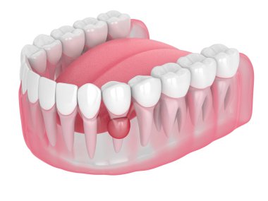 3d render of jaw with cyst on root