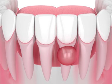 3d render of jaw with cyst on teeth root