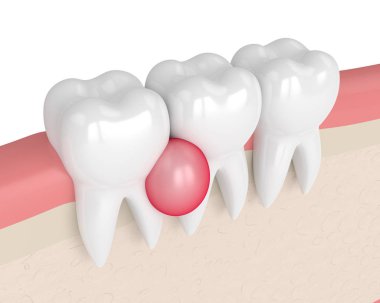 3d render of teeth in gums with cyst clipart