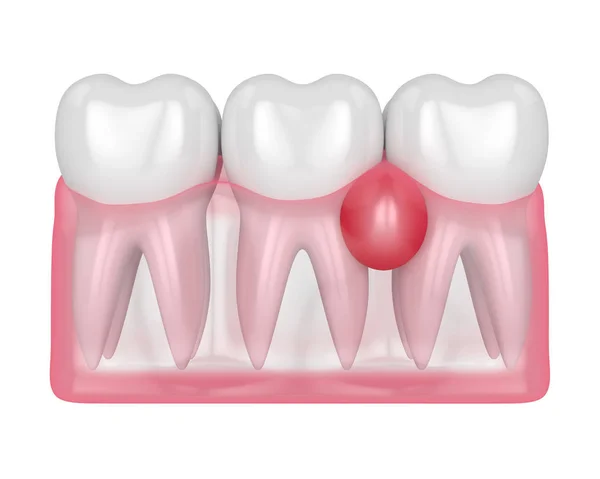 3d render of teeth in gums with cyst — Stock Photo, Image