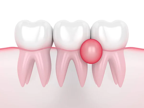 3D візуалізація зубів в яснах з кістами — стокове фото