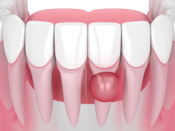 3d renderelés állkapocs ciszta foggyökér — Stock Fotó