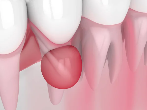3d renderização de dentes em gengivas com cisto — Fotografia de Stock