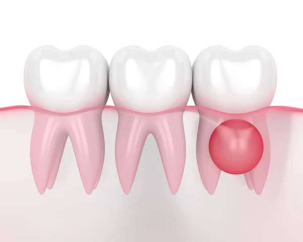 3d render of teeth in gums with cyst — Stock Photo, Image