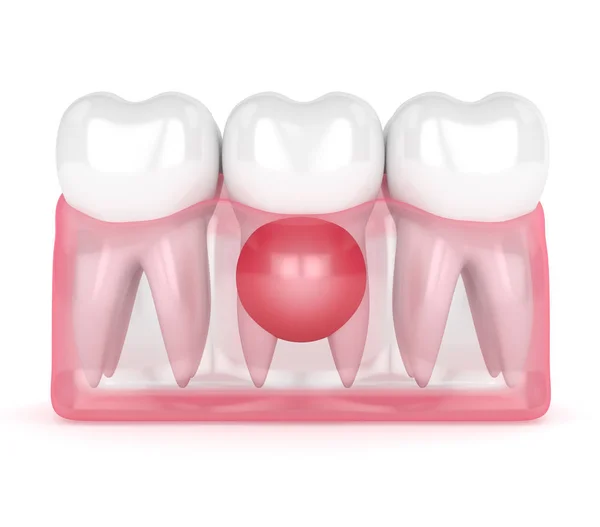 3d render of teeth in gums with cyst — Stock Photo, Image