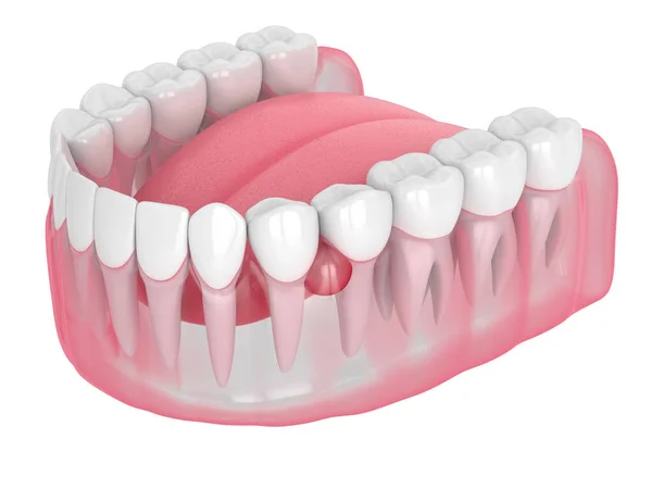 3D vykreslení čelisti a zubů s cystou — Stock fotografie