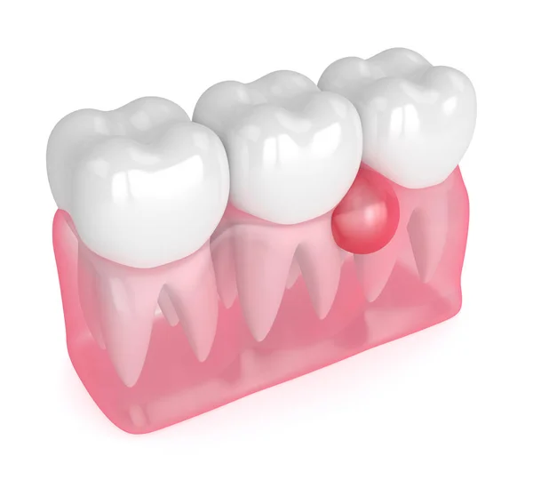 3d renderizado de dientes en encías con quiste —  Fotos de Stock