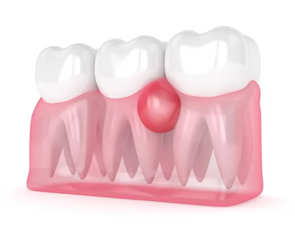 3d render of teeth in gums with cyst — Stock Photo, Image