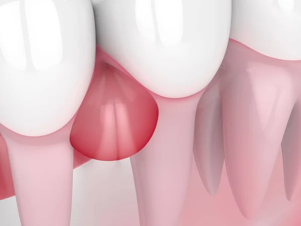 Rendering 3d dei denti nelle gengive con cisti — Foto Stock