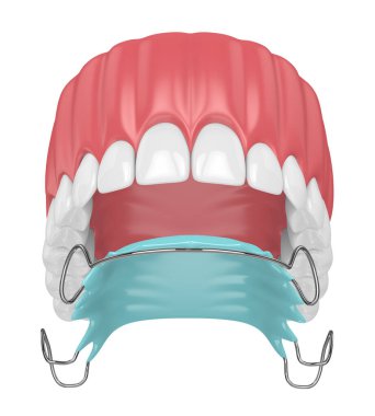 3d render of jaw with orthodontic removable retainer clipart