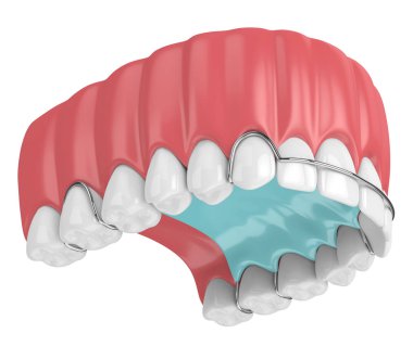 Ortodontik çıkarılabilir diş koruyuculu 3d çene oluşturucu