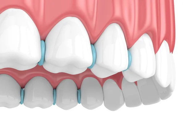 3d renderizado de separadores de goma entre dientes — Foto de Stock