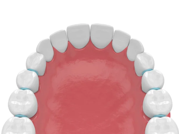 3d renderização de separadores de borracha entre dentes — Fotografia de Stock