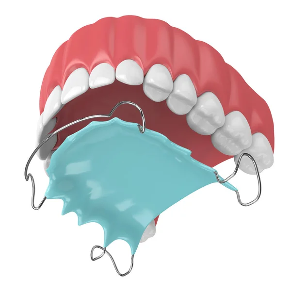 3d renderização da mandíbula com retentor removível ortodôntico — Fotografia de Stock