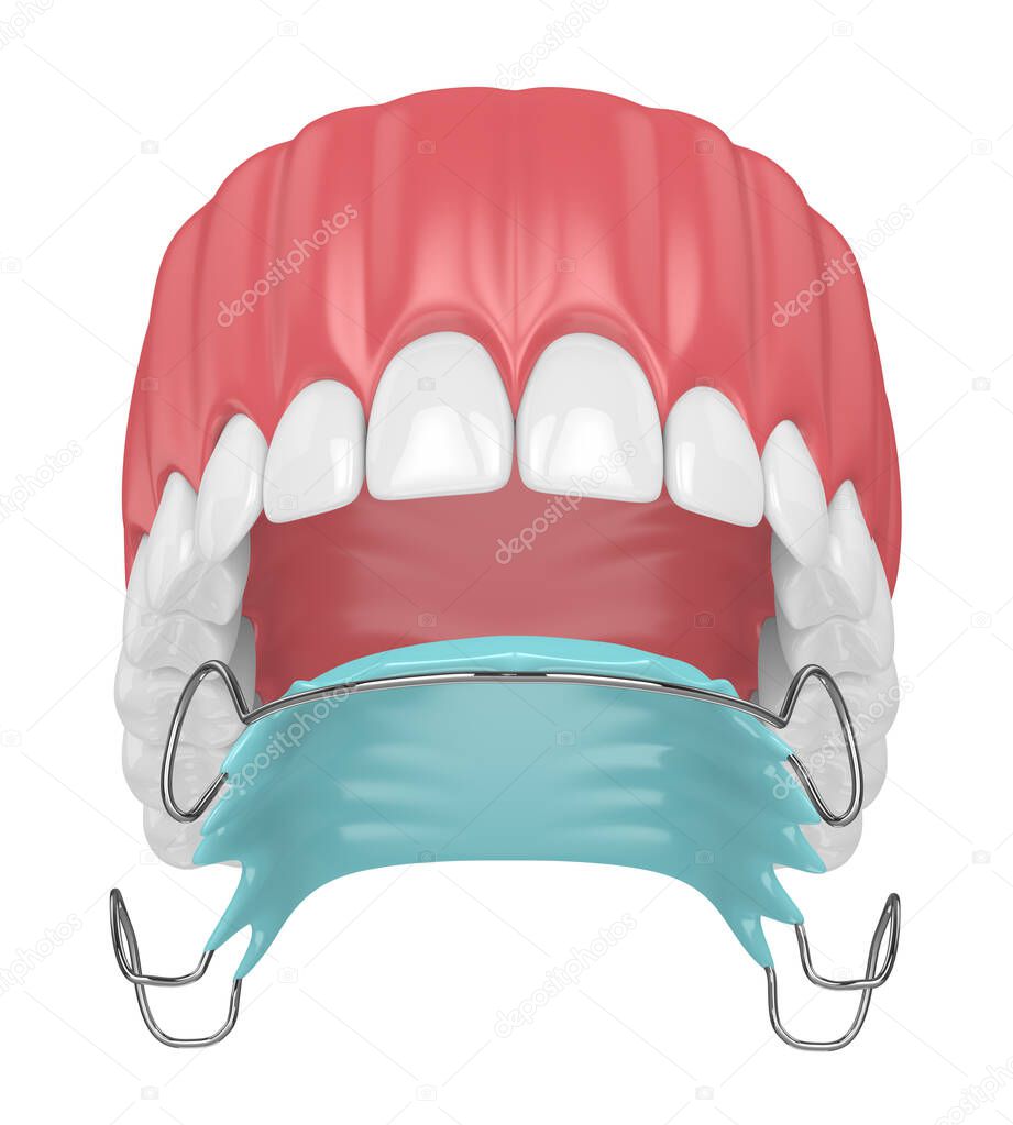 3d render of jaw with orthodontic removable retainer