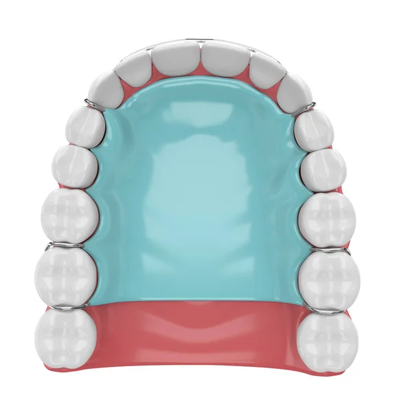 3d render of jaw with orthodontic removable retainer — 스톡 사진