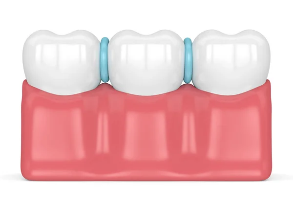 3d render of rubber separators between teeth — Stock Photo, Image