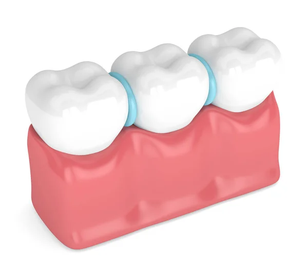 3d render of rubber separators between teeth — Stock Photo, Image