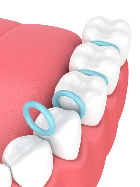 3d rendu de séparateurs en caoutchouc entre les dents — Photo