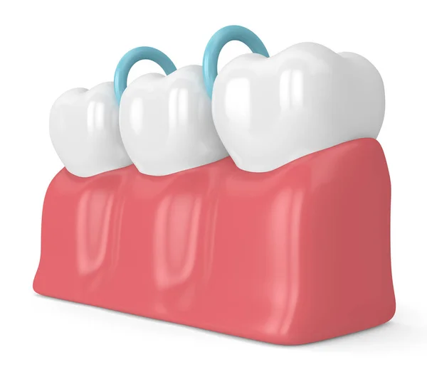 3d renderização de separadores de borracha entre dentes — Fotografia de Stock