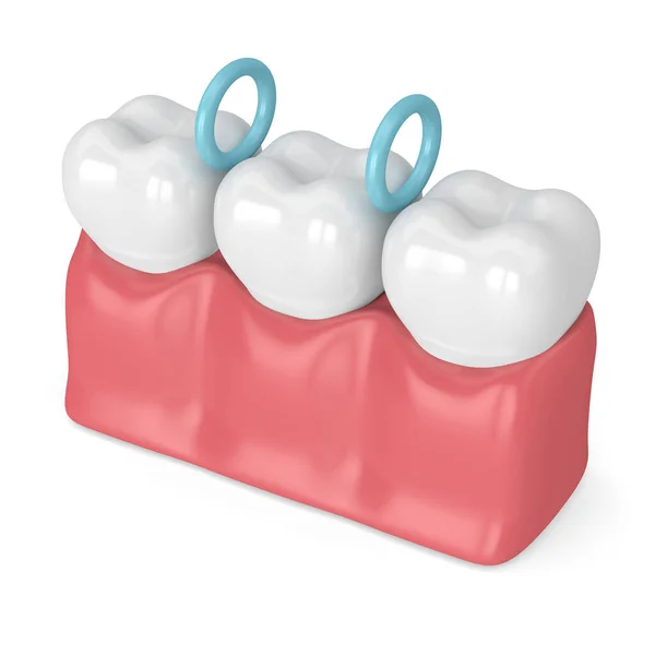 3d render of rubber separators between teeth — 스톡 사진