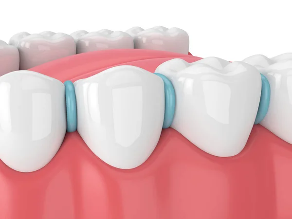 3d renderização de separador de borracha entre os dentes — Fotografia de Stock