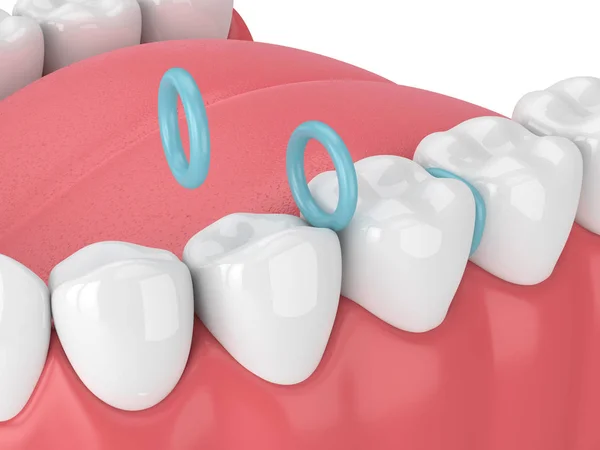 3D vykreslení pryžových separátorů mezi zuby — Stock fotografie