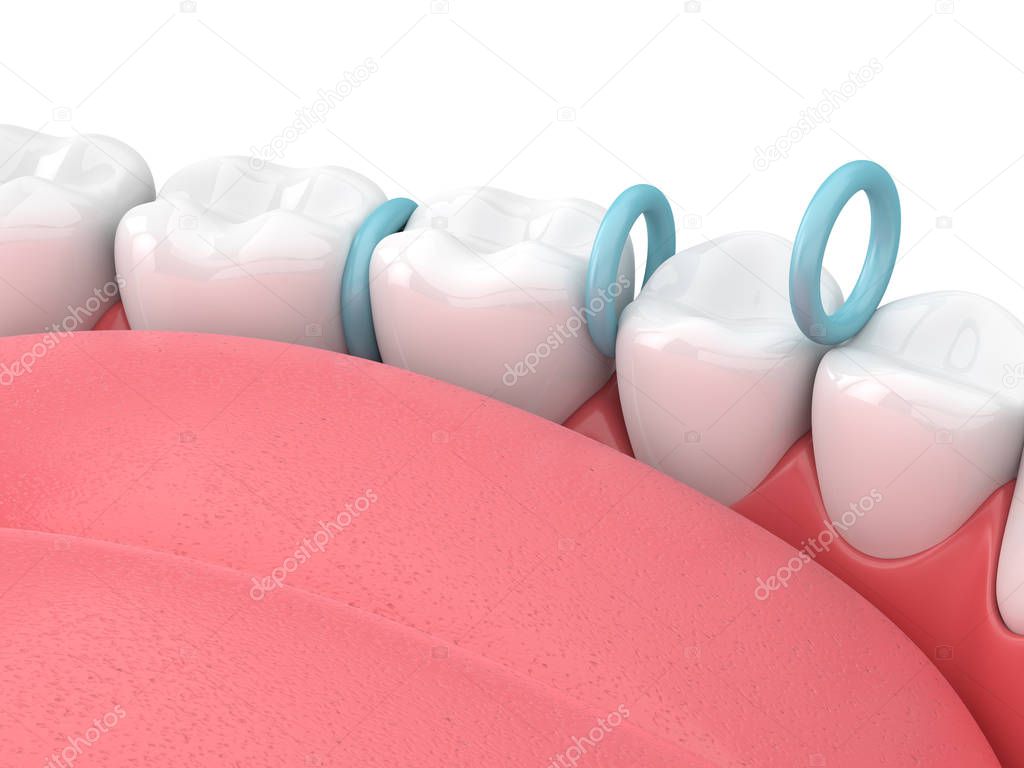 3d render of rubber separators between teeth