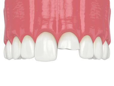 Kırık kesici dişli üst çenenin 3B görüntüsü