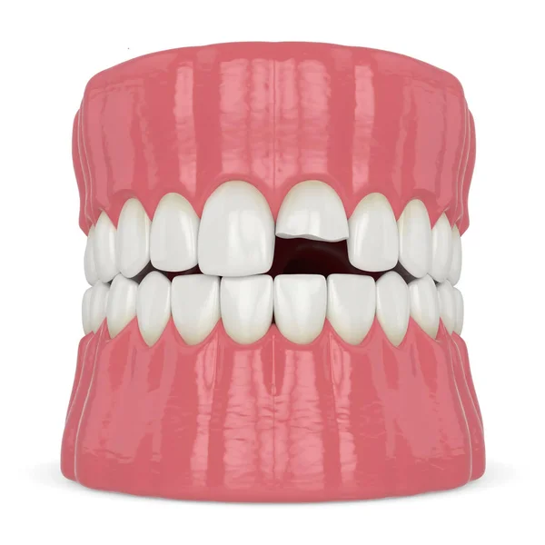 3D renderização da mandíbula com dente superior do incisivo quebrado — Fotografia de Stock