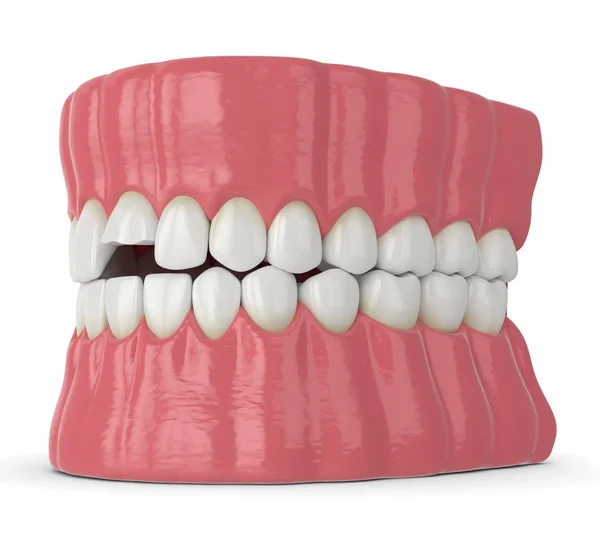 3D renderização da mandíbula com dente superior do incisivo quebrado — Fotografia de Stock