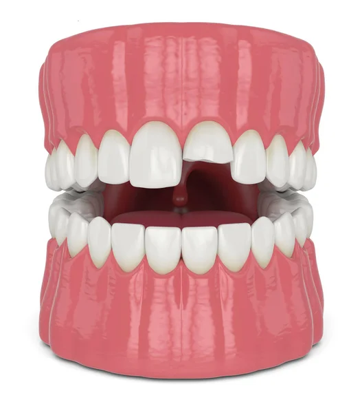3D återgivning av öppnad käke med bruten framtand övre tand — Stockfoto