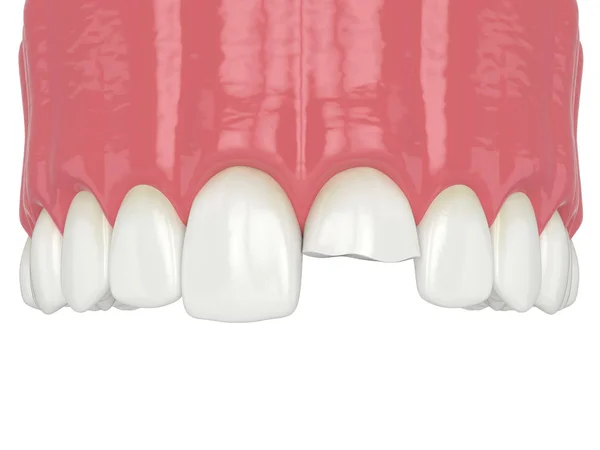 3d renderizado de mandíbula superior con diente incisivo roto — Foto de Stock