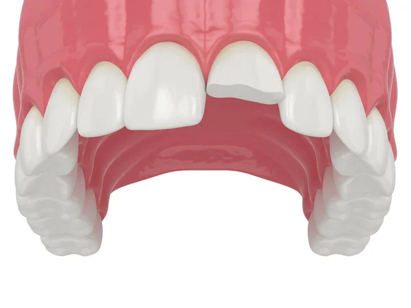 3d weergave van de bovenkaak met gebroken snijtand — Stockfoto