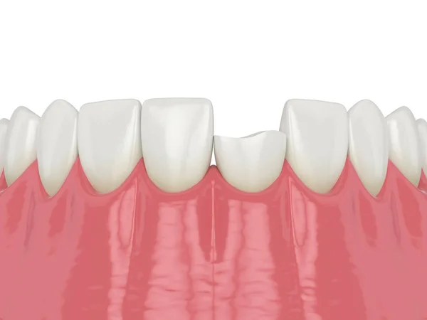 3d renderowanie dolnej szczęki ze złamanym zębem siekacza — Zdjęcie stockowe