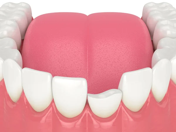 3D vykreslení dolní čelisti se zlomeným zubem řezáku — Stock fotografie