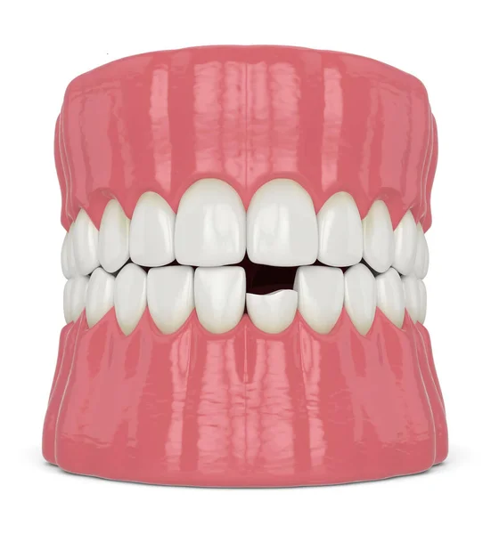 3d render of jaw with broken incisor lower tooth — Stock Photo, Image