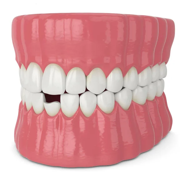 3d render of jaw with broken incisor lower tooth — Stock Photo, Image