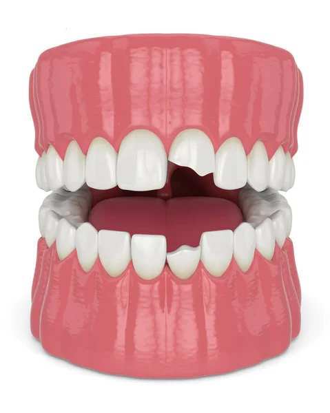 3d render of jaw with broken incisors teeth — Stock Photo, Image