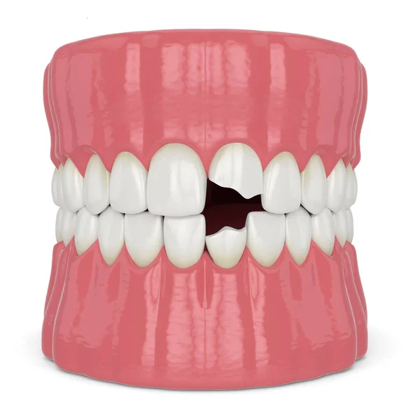 3d render of jaw with broken incisors teeth — Stock Photo, Image