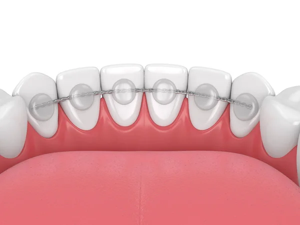 3d render of dental bonded retainer on lower jaw — Stock Photo, Image