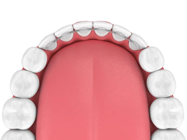 3d render of dental bonded retainer on lower jaw — 스톡 사진
