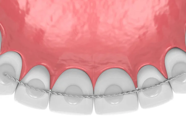 3d render of dental bonded retainer on upper jaw — Stock Photo, Image