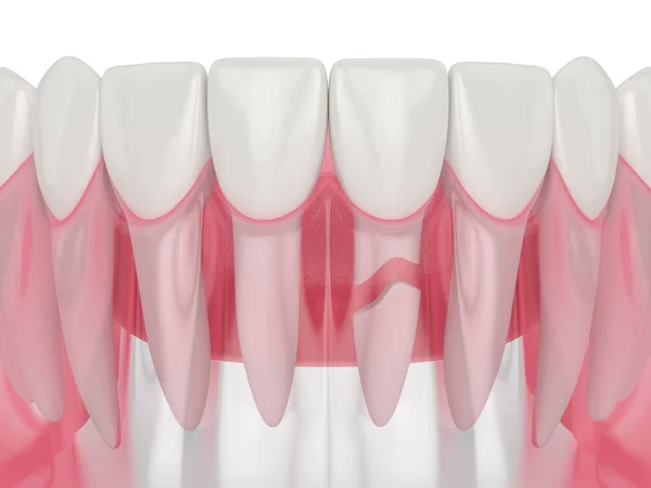 3D renderização da mandíbula com raiz de dente rachado — Fotografia de Stock
