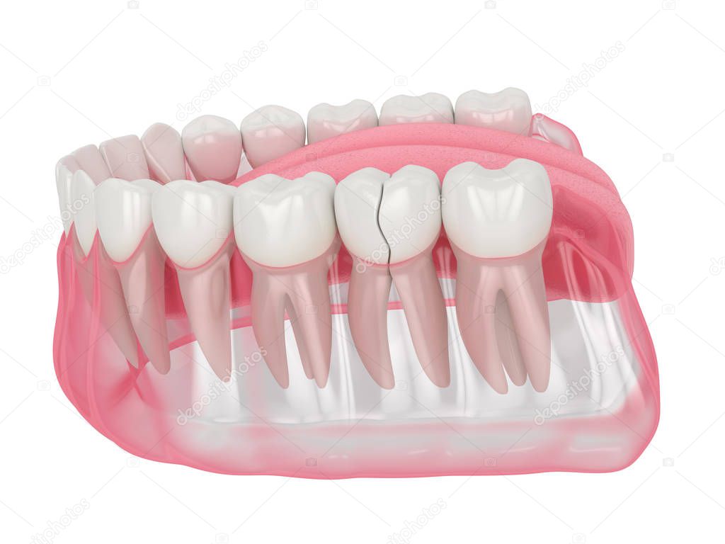 3d render of jaw with cracked tooth