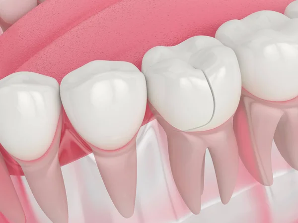 3D-Darstellung des Kiefers mit gebrochenem Zahn — Stockfoto