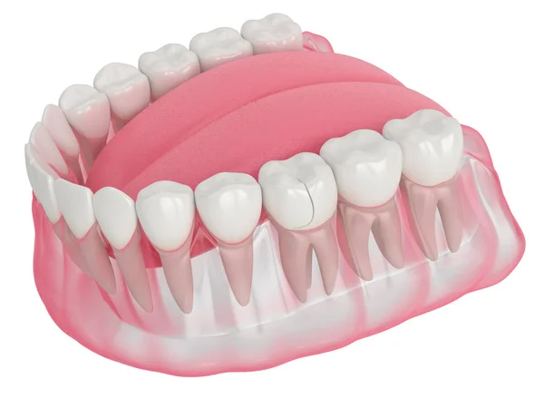 3d renderizado de mandíbula con diente fracturado — Foto de Stock