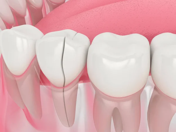 3D рендеринг челюсти с расщеплением зуба — стоковое фото
