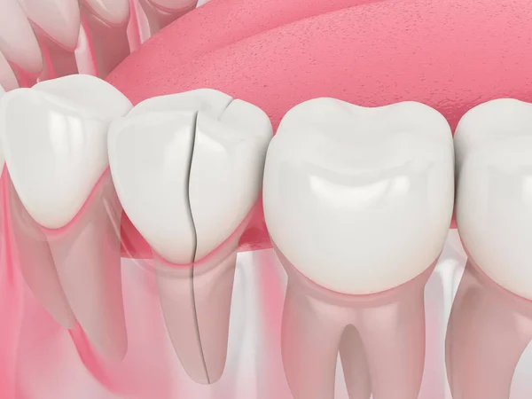 3d renderização da mandíbula com dente rachado — Fotografia de Stock